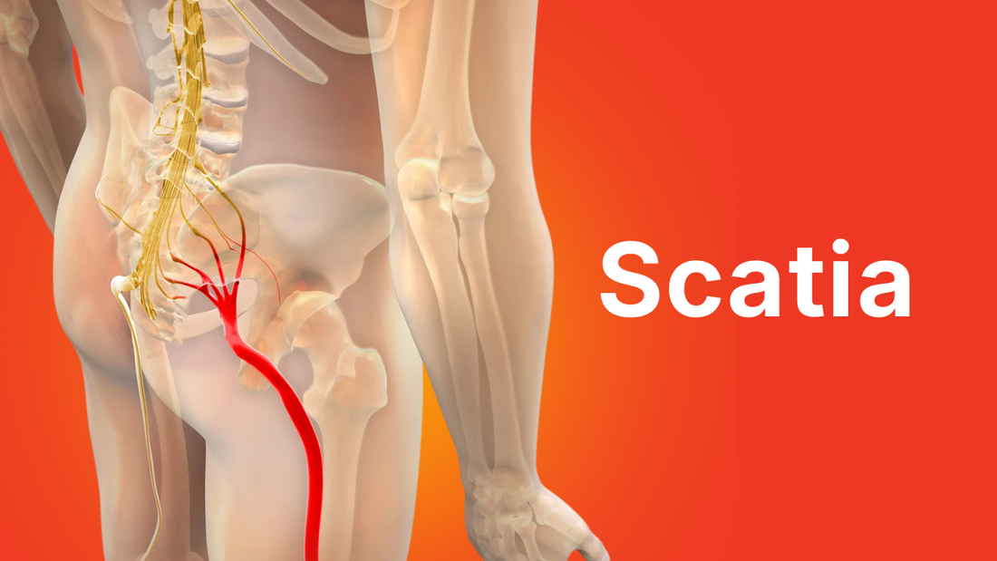 The Nerve That Won't Quit: Understanding Sciatica and How to Calm It Down